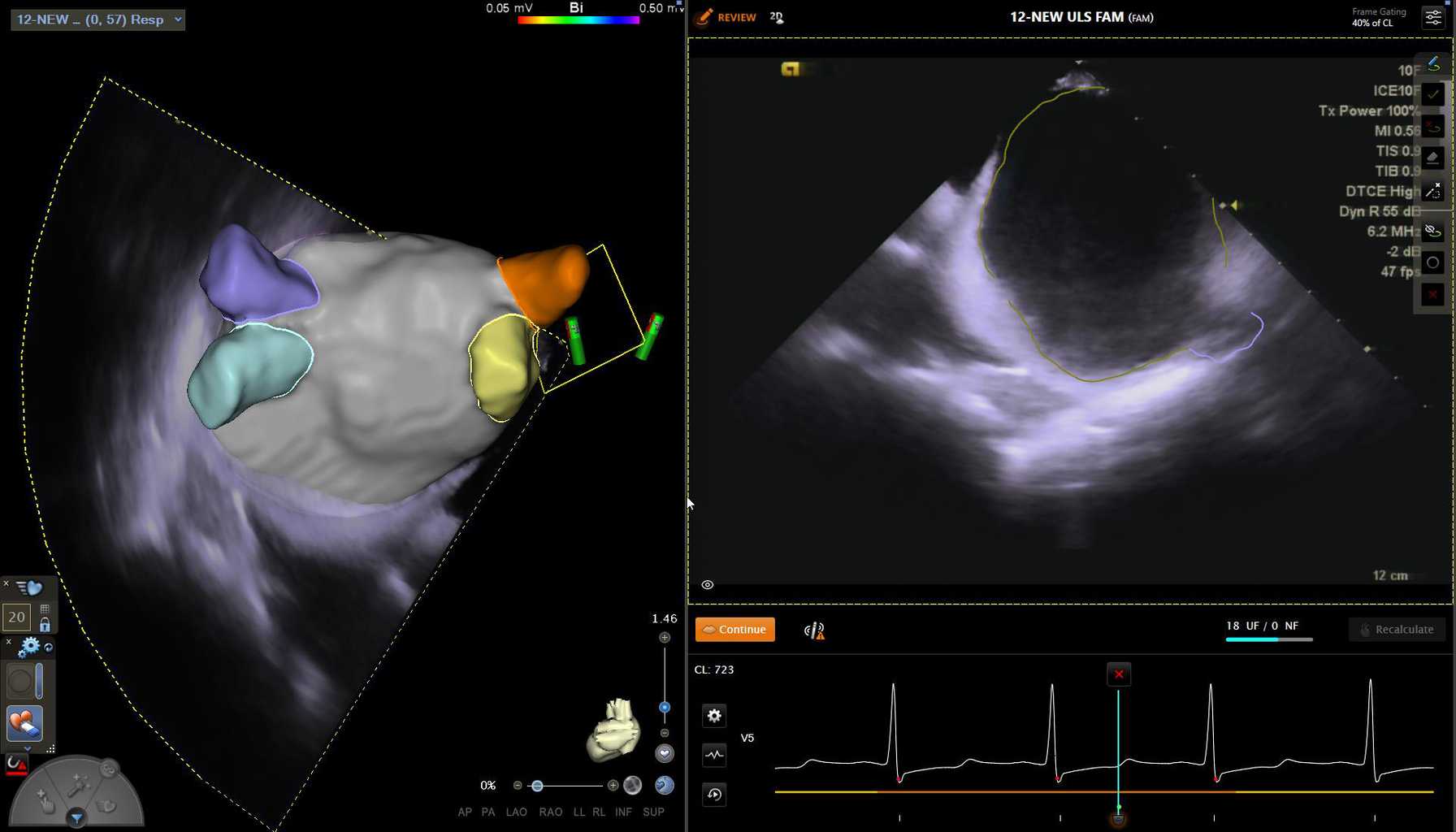 First Complete Radiation-Free Atrial Fibrillation Ablation Procedure Using AI 3D-Guided Ultrasound