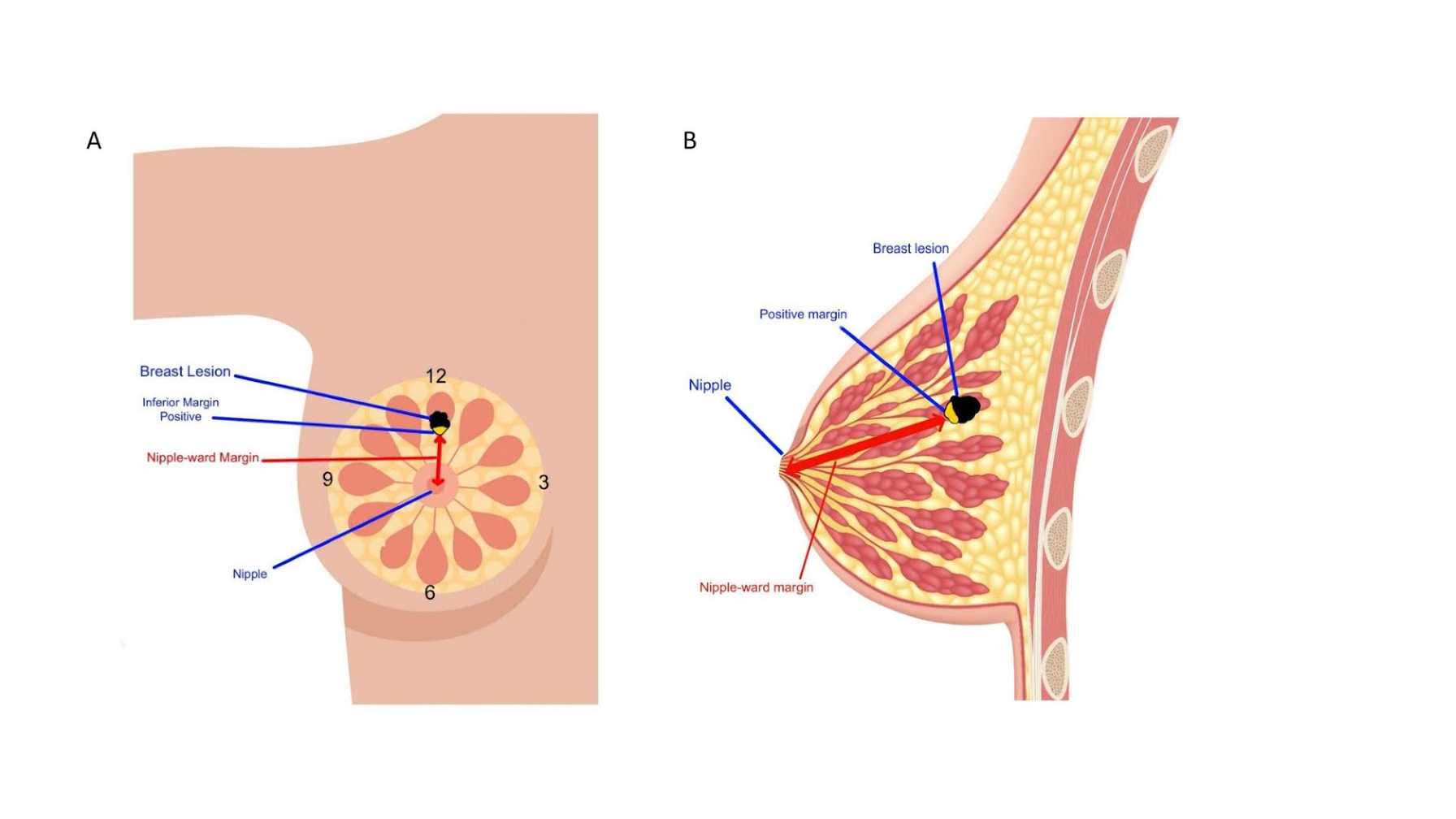 New Study Identifies Key Factor in Reducing Re-Excision Rates for Breast Cancer Lumpectomies