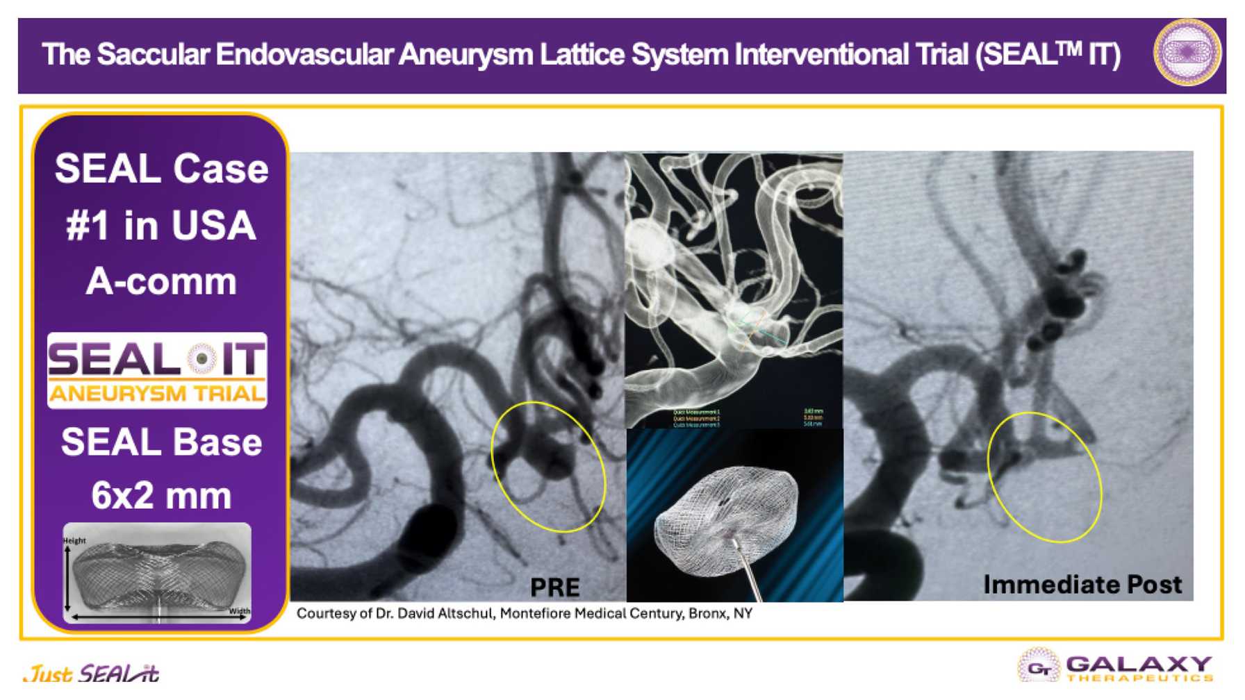 Advancing Endovascular Flow Disruptors for the Management of Wide-Necked Bifurcation Brain Aneurysms