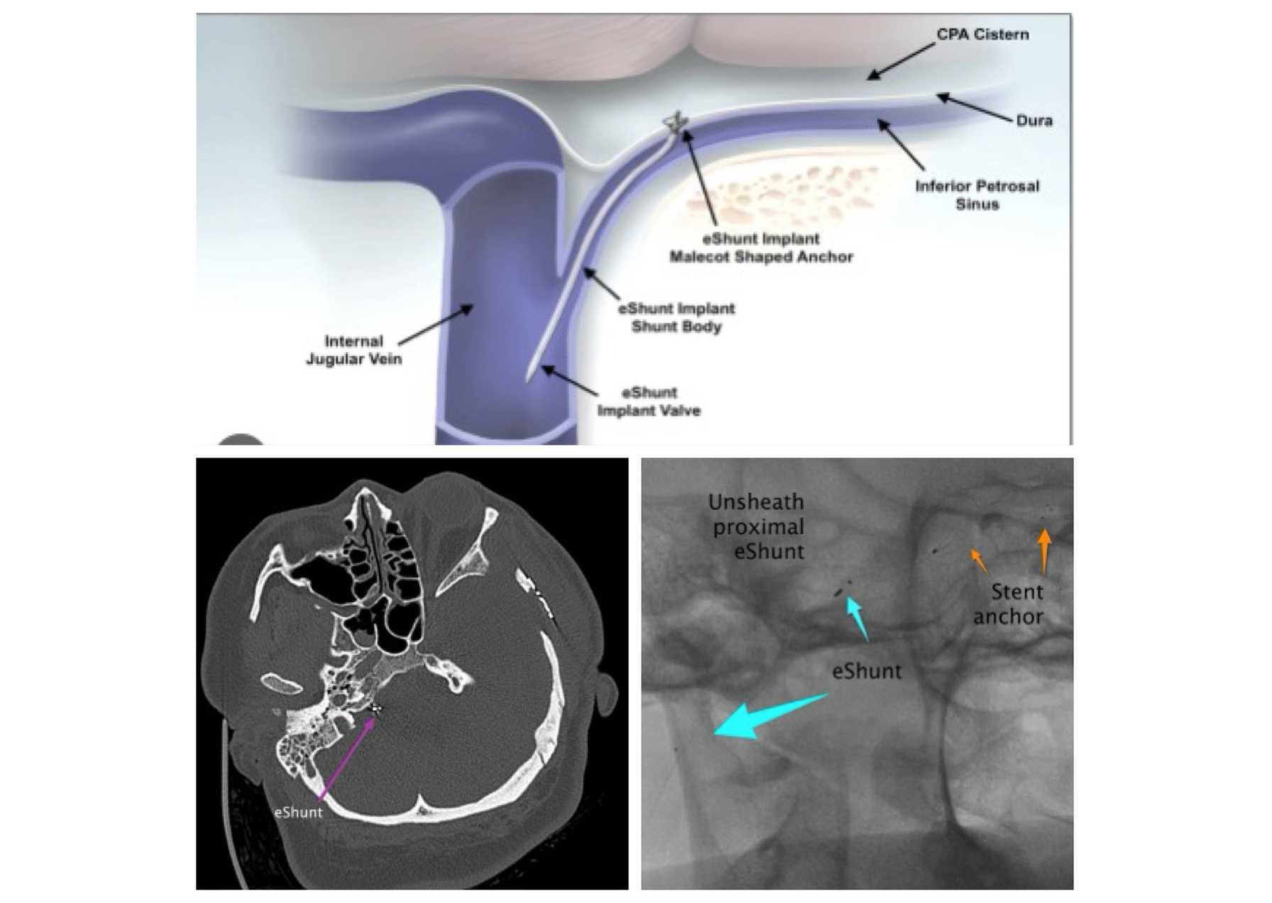 Reversing Disability with a New Minimally Invasive Endovascular Treatment for Normal Pressure Hydrocephalus