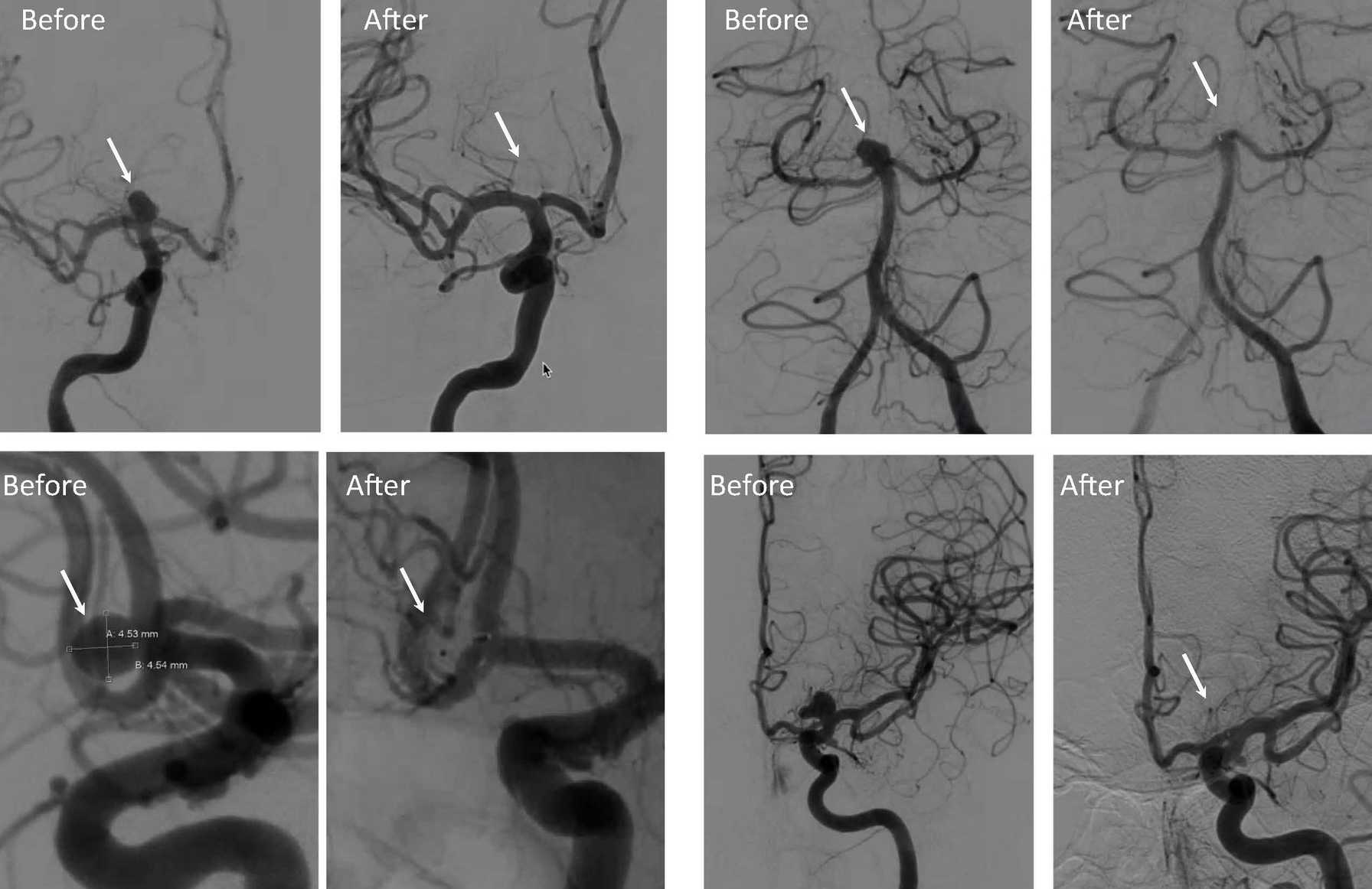 The Hardest Brain Aneurysm to Treat Can Now Be Safely Managed Without Any Skin Incision
