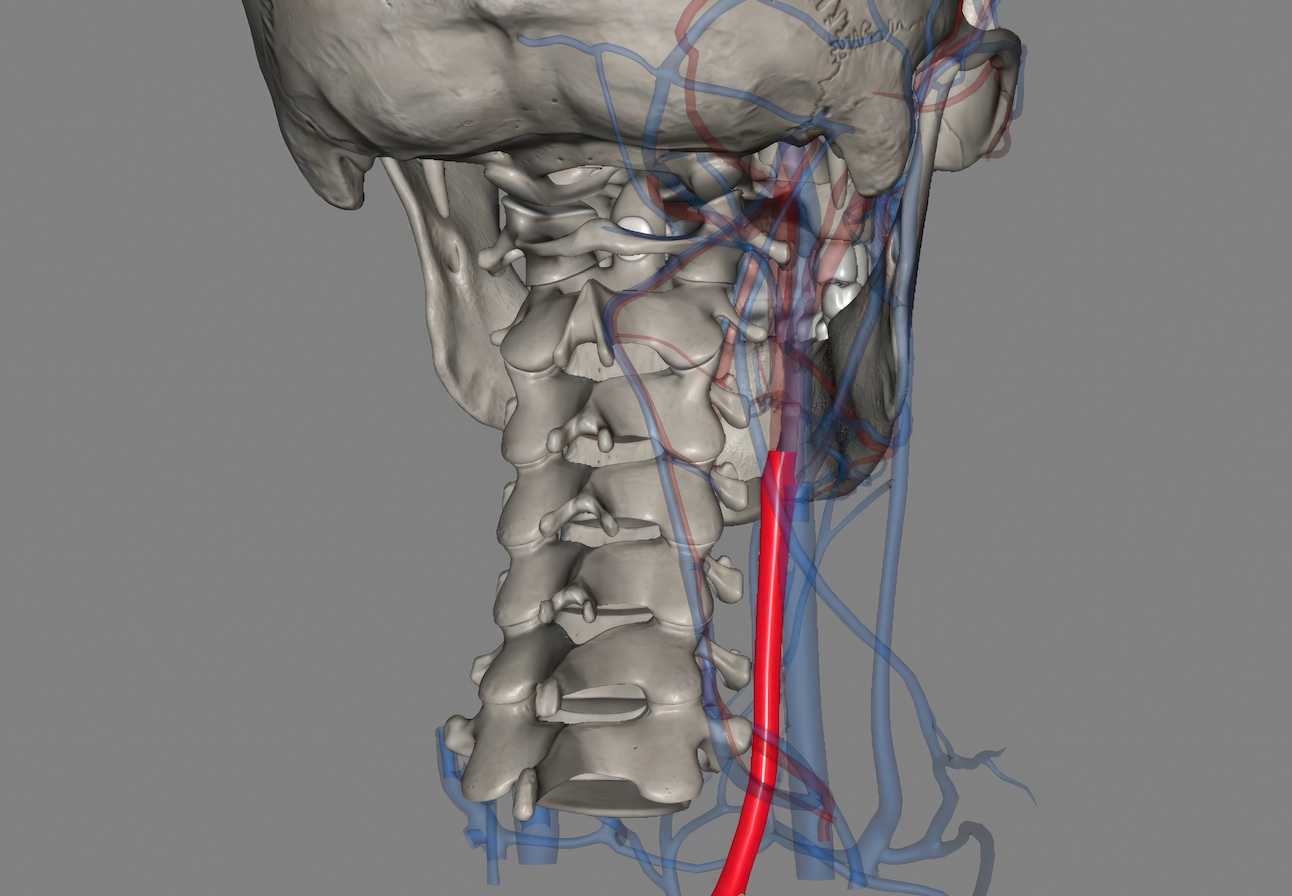 New Research Uncovers Hidden Stroke Risk in Healthy Younger Women from the Nation’s Largest Carotid Web Cohort