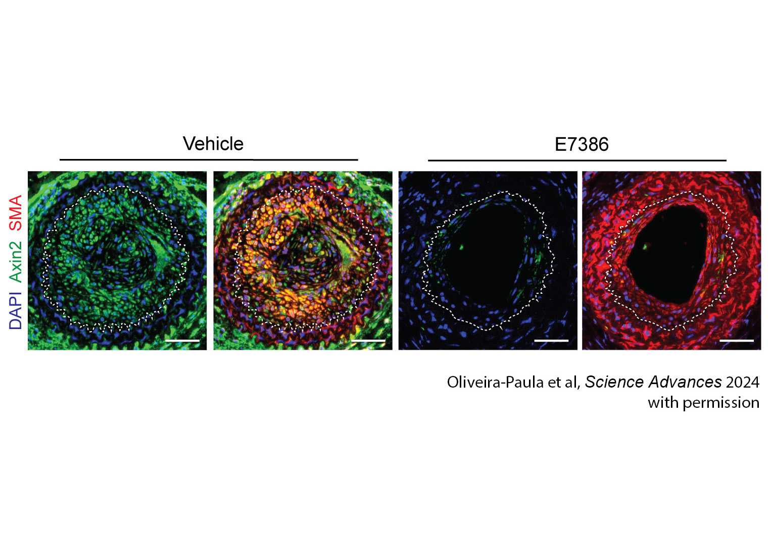 Discovery of New Target for the Treatment of Atherosclerosis