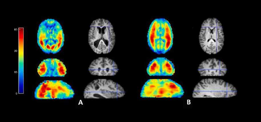 Novel Application of Elastography for the Evaluation and Treatment of Hydrocephalus