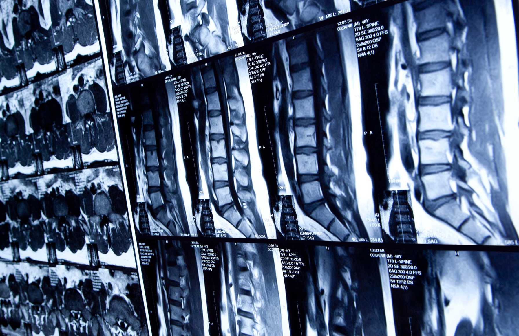 Minimally invasive approaches to spine oncology