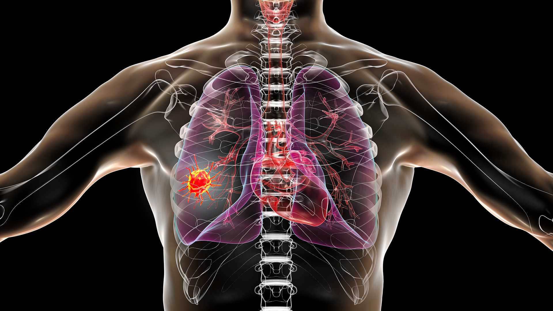 Breath Test for Detecting Lung Cancer | Montefiore Einstein